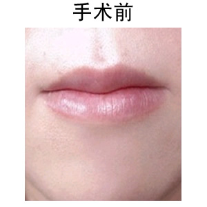 玻尿酸豐唇