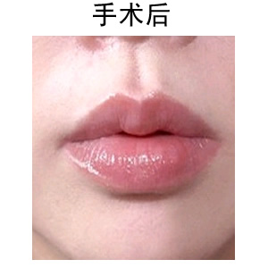 做玻尿酸豐唇