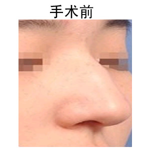 歪鼻子矯正手術(shù)