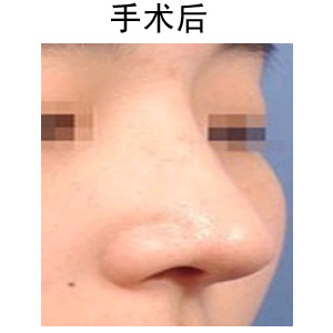 歪鼻子矯正術(shù)