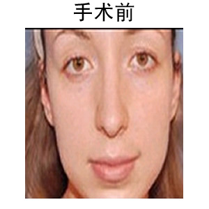 豐唇用什么材料效果