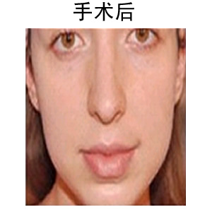 豐唇用什么材料效果好