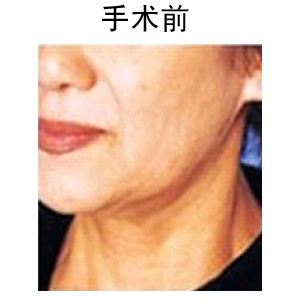 深藍射頻除皺多少錢
