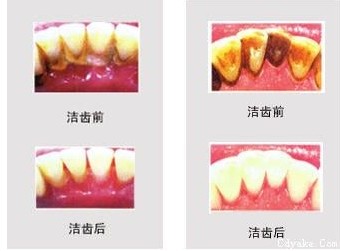 怎么保持牙齒清潔