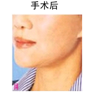 電波拉皮除皺