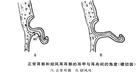 招風(fēng)耳整形