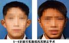 大耳朵招風(fēng)耳怎么辦