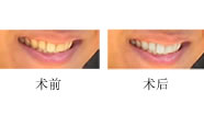 快速美白牙齒小妙招