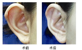 招風(fēng)耳好嗎