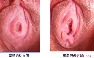 處女膜修復(fù)在青島要多少錢(qián)