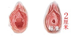 處女膜修復(fù)術(shù)時間