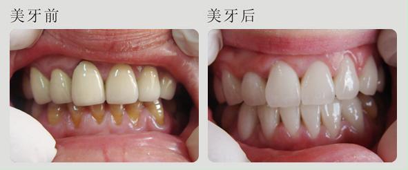 牙周病怎么治療