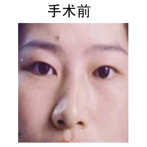 雙眼皮修復(fù)要多久時間