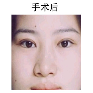雙眼皮修復(fù)要多久時間