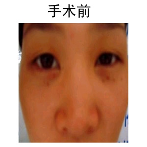臨沂雙眼皮修復(fù)