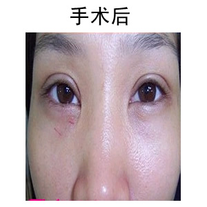 臨沂雙眼皮修復(fù)