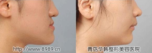 地包天矯正