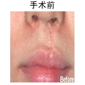 唇部整形修復術
