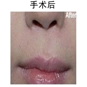 唇部整形修復術