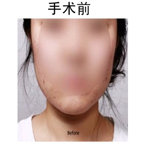 取頰脂墊價(jià)格