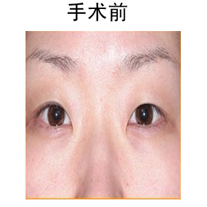 割雙眼皮手術