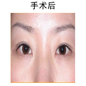 割雙眼皮手術