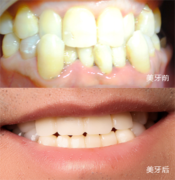 數(shù)字全瓷齒雕 讓笑容更加燦爛