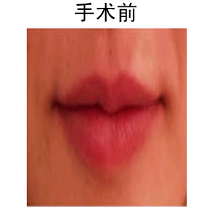 厚唇如何變薄