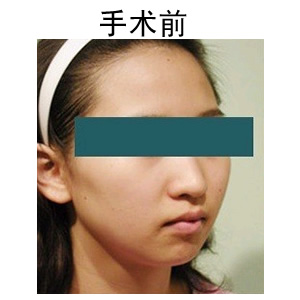 注射隆鼻多少錢(qián)