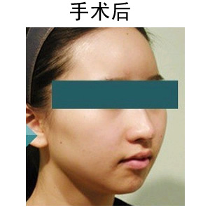 注射隆鼻要多少錢(qián)