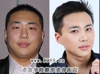 射頻瘦臉對(duì)比