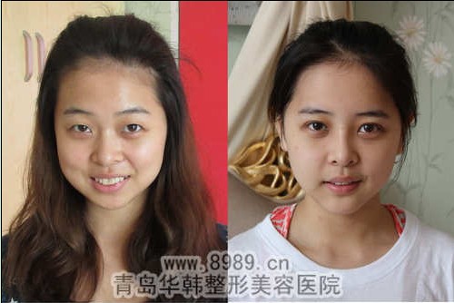 修改臉型對比