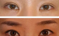 雙眼皮修復(fù)對(duì)比照