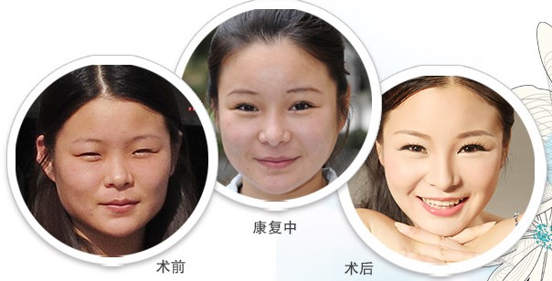 吳倩整形