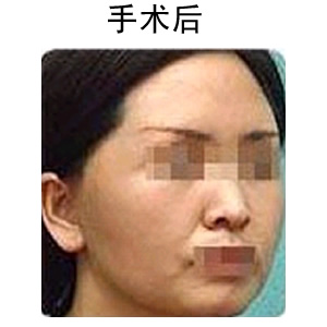 玻尿酸除皺多少錢(qián)