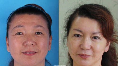 李東風(fēng)上瞼凹陷填充對比照片