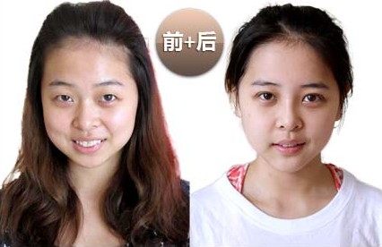 下頜角整形對(duì)比照