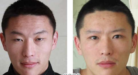 上瞼下垂矯正對(duì)比照