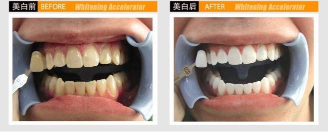洗牙會傷害牙齒嗎