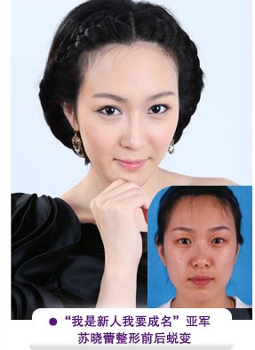 蘇曉蕾光子祛痘前后對比照片