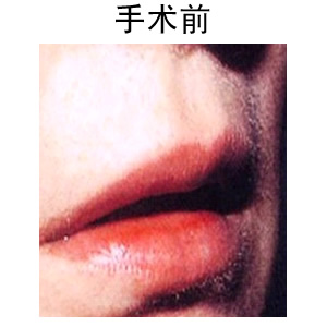 薄唇變厚的方法