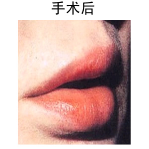 薄唇變厚的方法