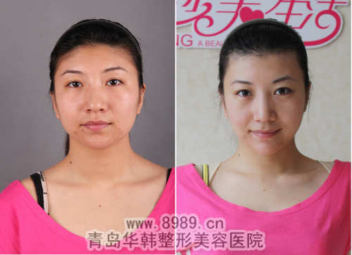 楊文華冰點脫發(fā)際線毛發(fā)前后對比照片