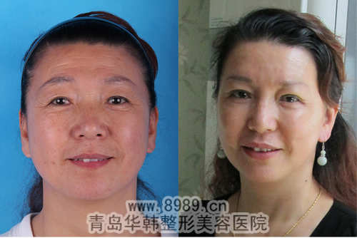 李東風(fēng)眼部吸脂前后對比照片