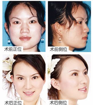 趙婷婷豐太陽穴前后對(duì)比照片