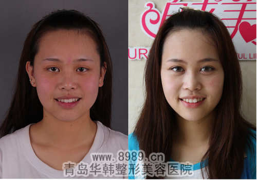 劉云冷光牙齒美白前后對(duì)比照片