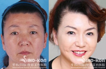 李東風(fēng)整形詳情