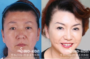 打針除皺可以保持多久