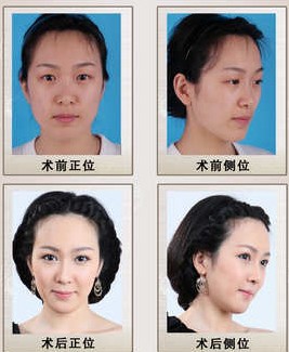 蘇曉蕾下頜角整形前后對比照片