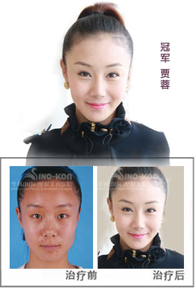 賈蓉彩光祛斑前后對(duì)比照片